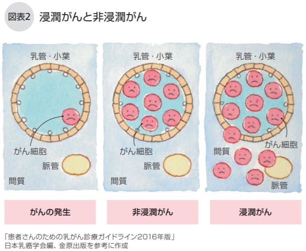 乳がんとは | NPO法人キャンサーネットジャパン